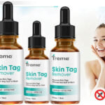 Treme' Skin Tag Remover