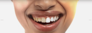 Soleil Glo Advanced Teeth Whitening