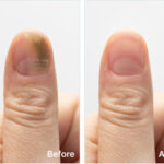 Cuticara Nail Fungus Solution