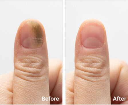 Cuticara Nail Fungus Solution